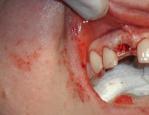 Што да направите кога ќе се извади заб и крварењето не престанува