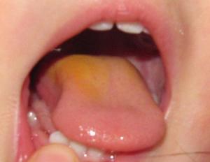 Causes of yellow plaque on the tongue