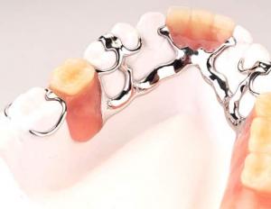 What are clasp dentures: recommendations for clasp prosthetics