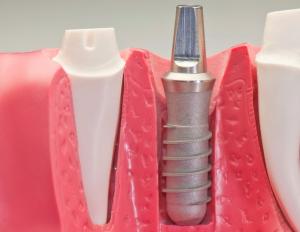 Typer tannimplantasjon og beskrivelse av prosedyren