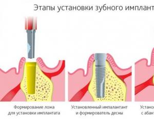Видове поставяне на зъбни импланти