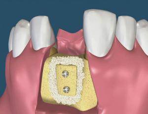 Hvordan plasseres tannimplantater og er det smertefullt å plassere dem, prisomtale