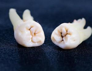 Чем полоскать зуб после удаления, чтобы ускорить заживление?