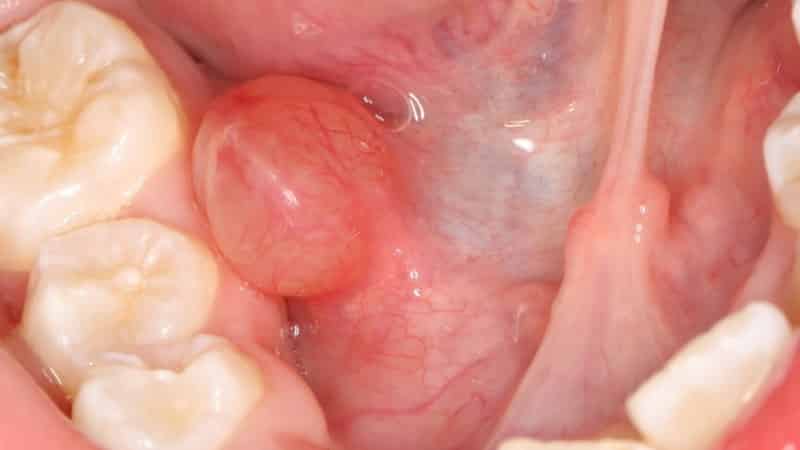 Tongue bubble under Bumps On