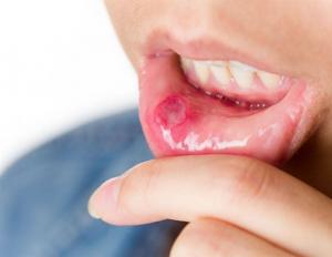 Blue against stomatitis: methods of use and possible side effects