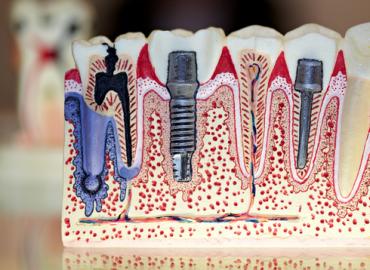 Процесс имплантации зубов по этапам