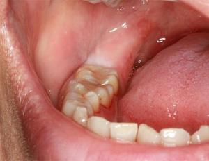 Is it painful to remove wisdom tooth?