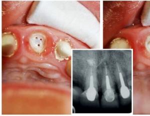 Tooth restoration without prosthetics - extension on a pin