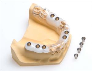 Everything you need to know about getting a dental implant