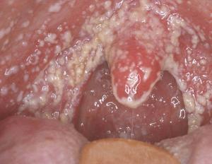 How is stomatitis treated at home?