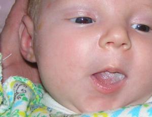 Why does my child have a white coating on his tongue?