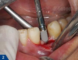 Имплантация зубов: отзывы, виды и цены