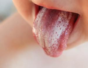 Hvorfor bliver et barns tunge dækket af en hvid belægning?