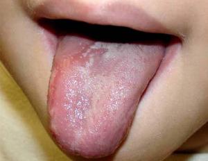 The child has a coating on his tongue