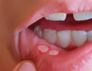 Как бързо да се отървете от стоматит в устата