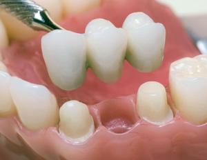Which crowns are better for back or front teeth?