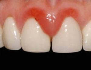 For what reason does gingivitis develop in children and the main methods of its treatment?