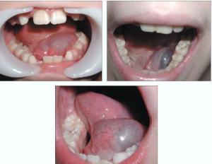 Методы лечения воспаления под языком