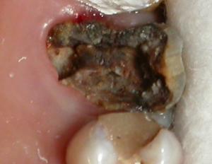 Больно ли удалять коренной зуб