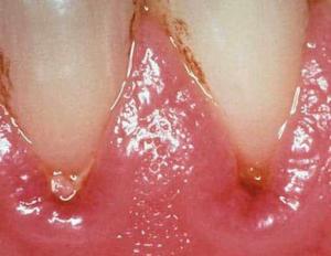 Hvordan og med hvad skal man behandle tandkødsbetændelse