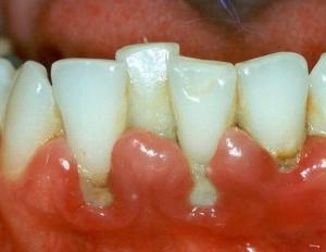Causes and treatment of gum inflammation