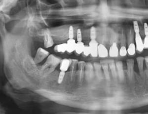 Как вставляют зубные импланты