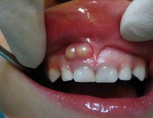White spots, spots on the gums in children