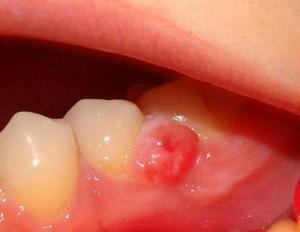 Dry socket after tooth extraction