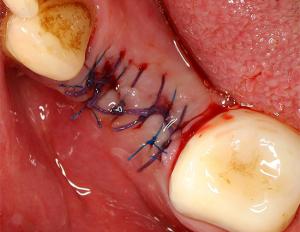 Чем следует полоскать рот после удаления зуба, чтобы десна быстрее зажила