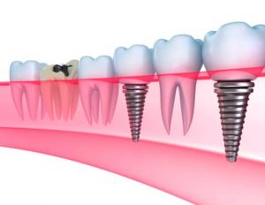 Description of the stages of dental implantation